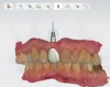 Fig 16. Presurgical design and fabrication of restorative components based on virtual implant position, allowing for possible minor angle/linear deviations (Fig 16 through Fig 18). Component options are broad and may include a custom healing abutment and bondable polymethyl methacrylate restoration; a single restoration with an engaging or non-engaging base; provisional fixed partial dentures (Fig 19), which can be indexed intraorally to prepared temporary abutments; or a full-arch restoration to be indexed intraorally to prepared temporary abutments.