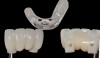 Fig 19. Presurgical design and fabrication of restorative components based on virtual implant position, allowing for possible minor angle/linear deviations (Fig 16 through Fig 18). Component options are broad and may include a custom healing abutment and bondable polymethyl methacrylate restoration; a single restoration with an engaging or non-engaging base; provisional fixed partial dentures (Fig 19), which can be indexed intraorally to prepared temporary abutments; or a full-arch restoration to be indexed intraorally to prepared temporary abutments.