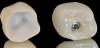 Fig 24. Full-contour monolithic crowns for teeth and implants constitute the last phase of the digital workflow.