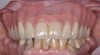 Fig 1. Patient presented with a screw-retained, full-arch restoration with full flange extension. Note there was no access for oral hygiene.