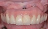 Fig 3. Nonsurgical peri-implant treatment was performed, and the existing prosthesis was modified to enable access for patient-administered oral hygiene.
