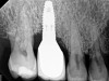 Fig 6. Radiographic bone loss confirmed the diagnosis of peri-implantitis.