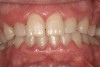 Fig 2. A 42-year-old male patient with good oral hygiene, taking 30 mg nifedipine daily, with signs of generalized gingival enlargement. (photo courtesy of Asim Alsuwaiyan, BDS)