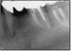 Fig 4. Case that quickly would proceed to implants.