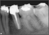 Fig 16. Radiograph after 4.5 years.
