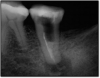 Fig 19. The tooth without the post.