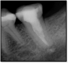 Fig 21. Radiograph 6 months later.