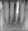 Fig 24. Radiograph at 2-year checkup.