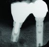 Fig 7 through Fig 14. Periapical radiographs of a 62-year-old woman who received a fixed porcelain-fused-to-metal reconstruction supported by abutments by internally connected dental implants. Fig 7 through Fig 10 are at initial prosthesis placement: mandibular site Nos. 30 and 29 (Fig 7); mandibular site Nos. 26, 25, and 23 (Fig 8); mandibular site Nos. 23 and 21 (Fig 9); mandibular site Nos. 21 through 19 (Fig 10). Fig 11 through Fig 14 are 11 years later (2013) and show excellent preservation of the vertical bone levels around the implants: mandibular site Nos. 30 and 29 (Fig 11); mandibular site Nos. 26 and 25 (Fig 12); mandibular site Nos. 25 and 23 (Fig 13); mandibular site Nos. 20 and 19 (Fig 14). It is interesting to note that in the mandibular right posterior quadrant there is a matched pair, ie, an external hex dental implant (No. 30) adjacent to an internally connected dental implant (No. 29). The bone levels around each of these designs are well-preserved at the 11-year follow-up.