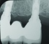 Fig 1 through Fig 6. Periapical radiographs of a 52-year-old man who received a fixed porcelain-fused-to-metal reconstruction supported by abutments attached to externally hexed dental implants. Fig 1 through Fig 3 are at initial prosthesis placement: maxillary right (Fig 1), textured surfaced threaded titanium implants at site Nos. 2, 4, and 6; maxillary anterior (Fig 2), implants at site Nos. 7 through 9; maxillary left (Fig 3), implants at site Nos. 12 and 14. Fig 4 through Fig 6 are 10 years post-insertion of the prosthesis: maxillary right (Fig 4), maxillary anterior (Fig 5), and maxillary left (Fig 6). Note minimal to no bone loss radiographically around the implants 10 years post-insertion of prosthesis.