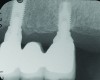 Fig 1 through Fig 6. Periapical radiographs of a 52-year-old man who received a fixed porcelain-fused-to-metal reconstruction supported by abutments attached to externally hexed dental implants. Fig 1 through Fig 3 are at initial prosthesis placement: maxillary right (Fig 1), textured surfaced threaded titanium implants at site Nos. 2, 4, and 6; maxillary anterior (Fig 2), implants at site Nos. 7 through 9; maxillary left (Fig 3), implants at site Nos. 12 and 14. Fig 4 through Fig 6 are 10 years post-insertion of the prosthesis: maxillary right (Fig 4), maxillary anterior (Fig 5), and maxillary left (Fig 6). Note minimal to no bone loss radiographically around the implants 10 years post-insertion of prosthesis.