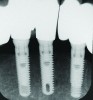 Fig 7 through Fig 14. Periapical radiographs of a 62-year-old woman who received a fixed porcelain-fused-to-metal reconstruction supported by abutments by internally connected dental implants. Fig 7 through Fig 10 are at initial prosthesis placement: mandibular site Nos. 30 and 29 (Fig 7); mandibular site Nos. 26, 25, and 23 (Fig 8); mandibular site Nos. 23 and 21 (Fig 9); mandibular site Nos. 21 through 19 (Fig 10). Fig 11 through Fig 14 are 11 years later (2013) and show excellent preservation of the vertical bone levels around the implants: mandibular site Nos. 30 and 29 (Fig 11); mandibular site Nos. 26 and 25 (Fig 12); mandibular site Nos. 25 and 23 (Fig 13); mandibular site Nos. 20 and 19 (Fig 14). It is interesting to note that in the mandibular right posterior quadrant there is a matched pair, ie, an external hex dental implant (No. 30) adjacent to an internally connected dental implant (No. 29). The bone levels around each of these designs are well-preserved at the 11-year follow-up.