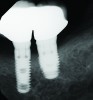 Fig 7 through Fig 14. Periapical radiographs of a 62-year-old woman who received a fixed porcelain-fused-to-metal reconstruction supported by abutments by internally connected dental implants. Fig 7 through Fig 10 are at initial prosthesis placement: mandibular site Nos. 30 and 29 (Fig 7); mandibular site Nos. 26, 25, and 23 (Fig 8); mandibular site Nos. 23 and 21 (Fig 9); mandibular site Nos. 21 through 19 (Fig 10). Fig 11 through Fig 14 are 11 years later (2013) and show excellent preservation of the vertical bone levels around the implants: mandibular site Nos. 30 and 29 (Fig 11); mandibular site Nos. 26 and 25 (Fig 12); mandibular site Nos. 25 and 23 (Fig 13); mandibular site Nos. 20 and 19 (Fig 14). It is interesting to note that in the mandibular right posterior quadrant there is a matched pair, ie, an external hex dental implant (No. 30) adjacent to an internally connected dental implant (No. 29). The bone levels around each of these designs are well-preserved at the 11-year follow-up.