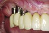 Fig 16 and Fig 17. Clinical photographs demonstrating bone loss and recession 20 years after prosthesis insertion. Initially the gingival margin covered the implant collars and threads. Fig 16: maxillary right; implants were placed at site Nos. 3 through 6. Fig 17: maxillary left; implants were placed at site Nos. 10 through 13.