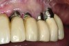 Fig 16 and Fig 17. Clinical photographs demonstrating bone loss and recession 20 years after prosthesis insertion. Initially the gingival margin covered the implant collars and threads. Fig 16: maxillary right; implants were placed at site Nos. 3 through 6. Fig 17: maxillary left; implants were placed at site Nos. 10 through 13.