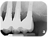 Fig 2. Radiograph suggested moderate bone loss around the implants.