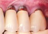 Fig 4. Clinical view of the area 3 months post-therapy. Shallow probings of 3 mm were present around the dental implants with absence of bleeding. However, the mucogingival deformities remained on the premolar implants and would require treatment.