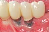 Fig 8. A mucogingival deformity existed on the premolar implants.
