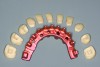 Fig 15. Pink anodized milled titanium frame with CAD/CAM-milled e.max® crowns that can be replaced by a digital copy if necessary.
