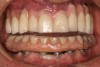 Fig 8. Five-year follow-up. Severe wear. Some chipping of ceramic facings of upper anterior PFM restorations against lower denture teeth. Wear changes incisal relationship from a Class I to end-to-end occlusion.