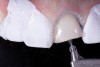 Fig 11. Air abrasion of enamel.
