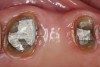 Fig 13. Crown preparations with temporary cement remnants prior to air abrasion (Fig 13) and after air abrasion (Fig 14) (case by Mohammed Badahman, DDS).