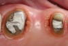 Fig 14. Crown preparations with temporary cement remnants prior to air abrasion (Fig 13) and after air abrasion (Fig 14) (case by Mohammed Badahman, DDS).