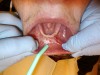 Fig 7. A horizontal CO<sub>2</sub> laser incision was made across muscle attachments starting at the left second premolar level toward the right second premolar. Note tension applied to the lower lip.