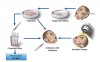 Fig 1. Suggested therapeutic model for salivary glands regeneration based on progenitor cell autotransplantation. The glands will be biopsied prior to the irradiation therapy, and SGIE cells will be cultivated during its timeframe. They will be transplanted to the irradiated glands and will replace the damaged cells. Concomitantly, a personal cell banking will be established.