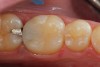 Fig 5. After light polymerization, occlusal adjustment, and polishing of restoration.