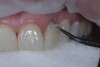 Fig 3. An adhesive was applied to tooth No. 10 and light-cured.