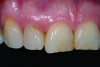 Fig 1. Preoperative view of the patient's natural teeth showing discoloration and wear that detracted from the esthetics of her smile.