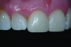 Fig 7. Postoperative view of the direct composite restorations that, although minimally invasive, created a dramatic improvement in the appearance of the patient's smile.