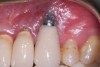 Fig 1. Implant with zirconia abutment had peri-implantitis that led to gingival recession and exposure of the implant body.