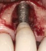 Fig 3. Clinical and radiographic views of an external hexagon implant restored using a zirconia abutment. The radiograph indicates an implant–abutment connection vulnerable to microleakage. Severe bone loss was due to peri-implantitis.