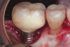 Fig 5. Emergence profile of this abutment and crown created a less-than-ideal prosthetic design similar to that of a “lollipop” on a stick.