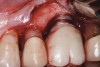 Fig 7. Excess cement remnants discovered along the abutment–crown margin predisposed this implant to developing peri-implantitis.