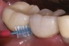 Fig 8. Adequate space has been provided to permit insertion of an interdental brush mesial and distal to implant site No. 30.