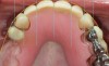 Fig 12 through Fig 14. Digital smile design software enables parameters of interim prosthesis to be facially generated; (Fig 12) front view, (Fig 13) occlusal view, (Fig 14) 12 o’clock view.