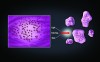 Fig 5. Utilization of prepolymerized filler particles for microfilled and nanofilled composite resins.