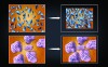 Fig 6. Large interparticle distances do not create any frictional contact during polymerization, allowing greater shrinkage (upper two images). Large prepolymerized particles contact one another during polymerization and help resist volumetric shrinkage (lower two images).