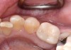 Fig 2. Screw-retained monolithic zirconia crown cemented to a titanium base.