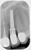 Fig 7. Ill-fitting milled abutment obtained from a third-party vendor and not from the manufacturer.