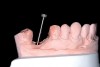 Fig 12. Path of draw necessitates adjustment to adjacent tooth or cement-retained restoration.