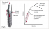 Fig 5. External hex implants rely entirely on the preload of the screw to maintain a tight, stable connection. In this example, the use of a coated abutment screw designed specifically for integration with the implant system achieved an ideal preload and intimate fit.