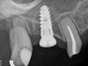 Fig 21. Day of sinus augmentation and implant placement in the No. 3 position. The sinus membrane has been raised about 7 mm to 8 mm.