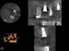 Fig 22. CBCT scan (Kodak 9000D) of No. 3 area, day of placement. Appearance of native bone and bone graft is clearly discernible.