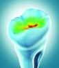 Fluorescence-based caries detection technology can be used to observe a pulsing red LED to indicate the presence and intensity of demineralization.