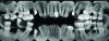 Fig 3. Gross caries and severe periodontitis in a patient presenting with a chief complaint of halitosis.