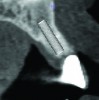 Fig 2. Cross-sectional view of proposed implant
position. Note that the plan allows the restorative doctors and surgeon to confirm the implants’ position, inclination, depth, and
emergence.